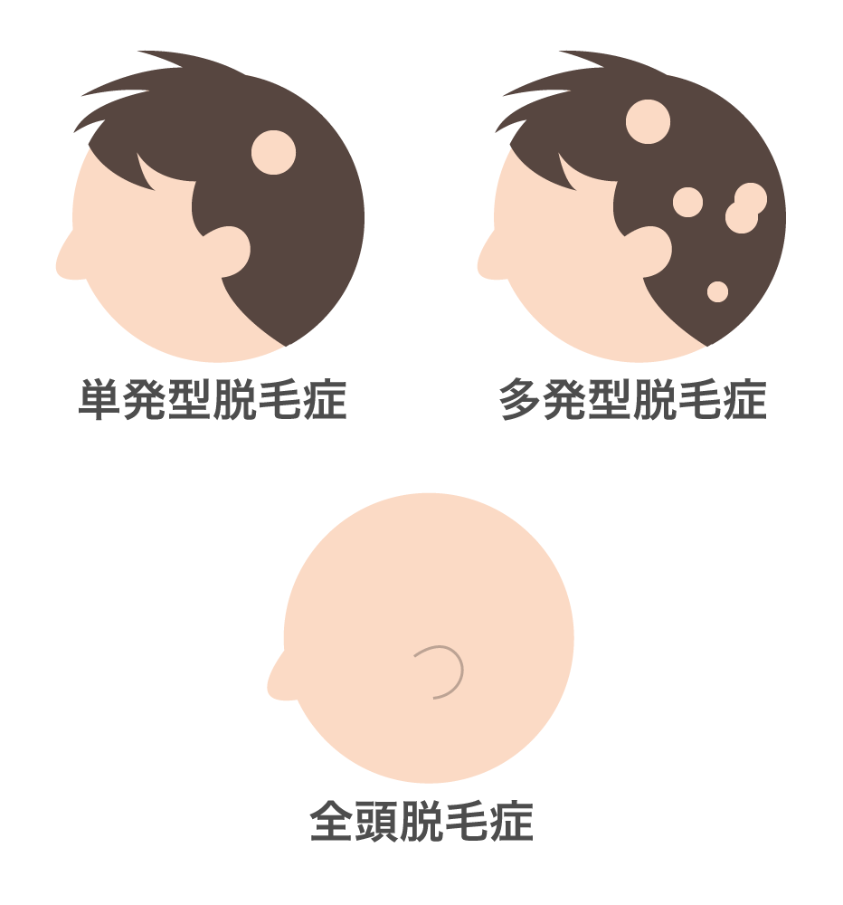 円形脱毛症の分類
