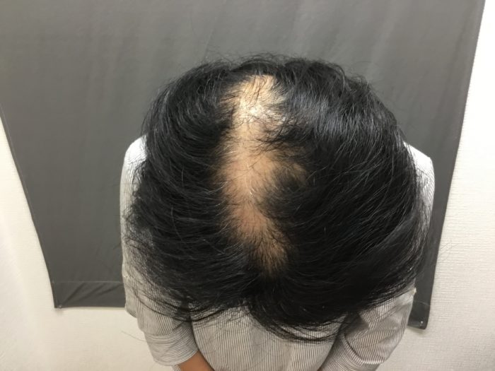 急激に進行する円形脱毛症、FAGAの患者様 （56歳女性） 駅前AGAクリニック【新宿、北千住、大阪、京都、岡山、鹿児島】