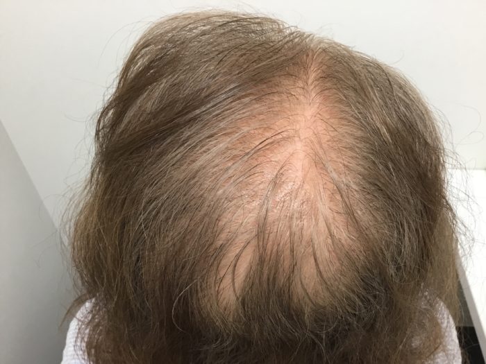 女性型脱毛症の原因は何ですか？