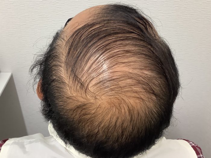 AGA患者様（61歳男性　H-N分類 Ⅵ型）、四日市、初診時、頭頂部を撮影