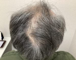 AGAで治療前の頭皮写真です。