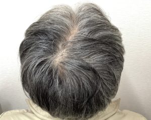 AGAで治療後の頭皮写真です。