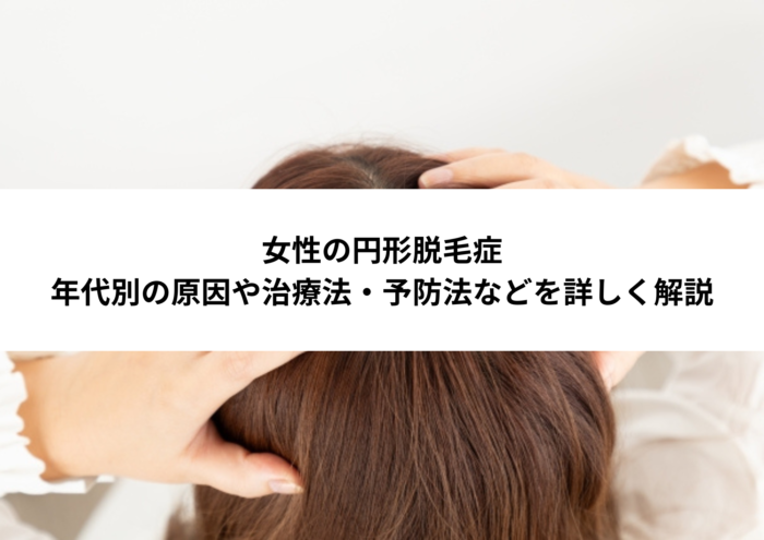 女性の円形脱毛症|年代別の原因や治療法・予防法などを詳しく解説