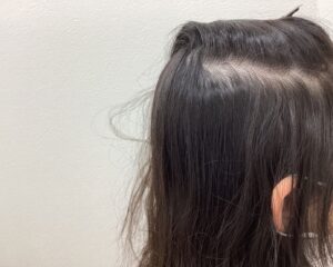 急速進行性びまん脱毛症治療2週間経過　9歳女児　側頭部　横浜院