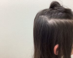 急速進行性びまん脱毛症治療前　9歳女児　側頭部　横浜院