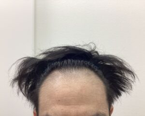 AGA治療前 43歳男性 頭頂部薄毛 新潟院