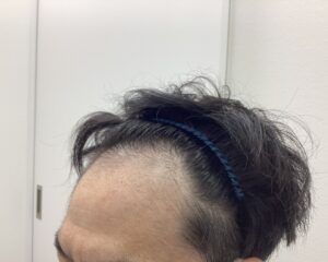 AGA治療前 43歳男性 頭頂部薄毛 新潟院