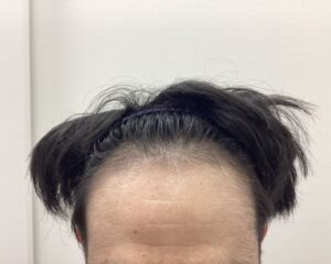 AGA治療6ヵ月後 43歳男性 頭頂部改善 新潟院