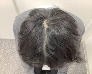 AGA治療1年4ヵ月後 43歳男性 頭頂部改善 新潟院