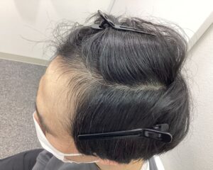AGA治療1年4ヵ月後 43歳男性 頭頂部改善 新潟院