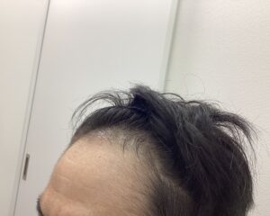 AGA治療6ヵ月後 43歳男性 頭頂部改善 新潟院