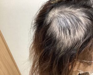  多発型の円形脱毛症治療1ヵ月経過　47歳女性　横浜院