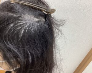  多発型の円形脱毛症治療3ヵ月経過　47歳女性　横浜院