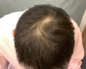 AGA治療10カ月後　47歳男性　頭頂部改善　金沢院