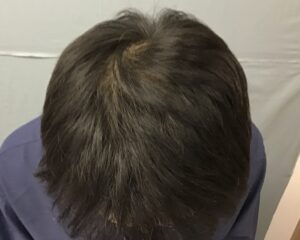 AGA治療10カ月後　47歳男性　頭頂部改善　金沢院