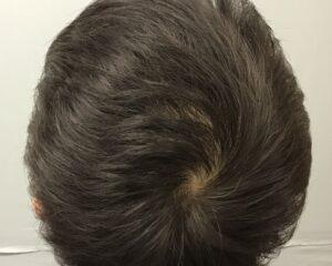 AGA治療10カ月後　47歳男性　頭頂部改善　金沢院
