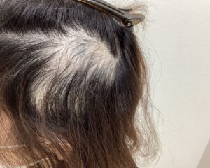  多発型の円形脱毛症治療1ヵ月経過　47歳女性　横浜院