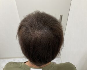 AGA治療3ヵ月後　57歳男性　つむじ改善　岡山院