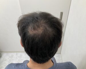 AGA治療前　57歳男性　つむじ薄毛　岡山院