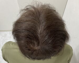 AGA治療10ヵ月後　57歳男性　生え際・頭頂部薄毛改善　岡山院