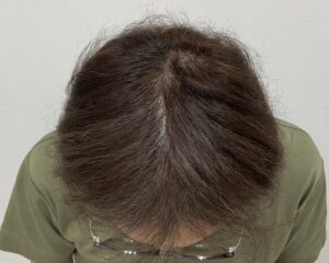 AGA治療10ヵ月後　57歳男性　生え際・頭頂部薄毛改善　岡山院