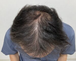 AGA治療前　57歳男性　生え際・頭頂部薄毛　岡山院