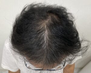 AGA治療3ヵ月後　57歳男性　生え際・頭頂部薄毛　岡山院