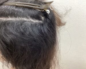  多発型の円形脱毛症治療後　47歳女性　横浜院
