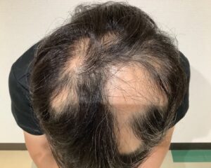 多発型の円形脱毛症治療前　46歳男性　姫路院