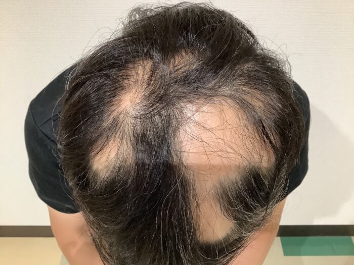 【46歳男性】多発型の円形脱毛症がメソセラピーで改善｜姫路院