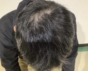 多発型の円形脱毛症治療後　46歳男性　姫路院