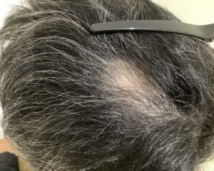 多発型の円形脱毛症治療後　46歳男性　姫路院
