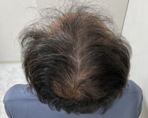 AGA治療前　57歳男性　生え際・頭頂部薄毛　岡山院