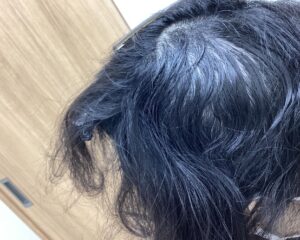  多発型の円形脱毛症治療3ヵ月経過　47歳女性　横浜院