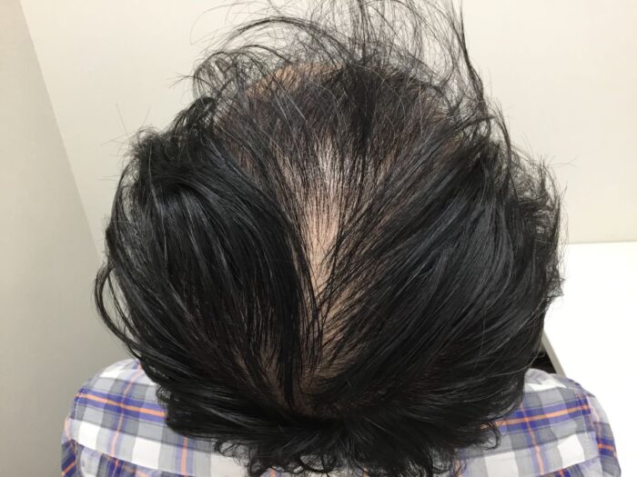 【41歳男性】生え際・頭頂部の薄毛がAGA治療で改善｜大阪梅田院
