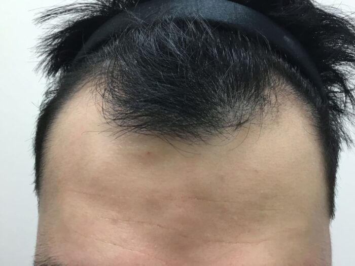 【25歳男性】生え際・頭頂部の薄毛がAGA治療で改善｜大阪梅田院