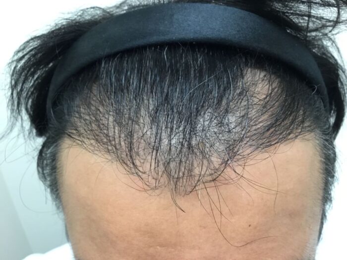 【50歳男性】生え際・頭頂部の薄毛がAGA治療で改善｜大阪梅田院