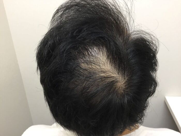 【36歳男性】生え際・頭頂部の薄毛がAGA治療で改善｜大阪梅田院