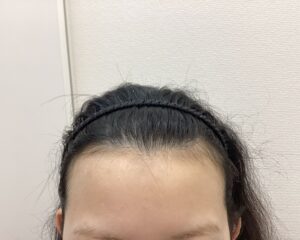AGA治療前　20歳女性　生え際・頭頂部薄毛　新潟院