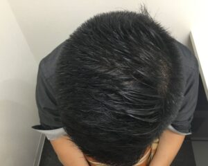 AGA治療後＿40歳男性＿生え際・頭頂部の改善＿大阪梅田院