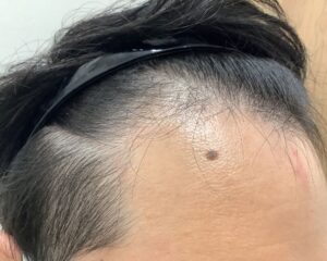 AGA治療前＿25歳男性＿生え際・頭頂部の薄毛＿広島院