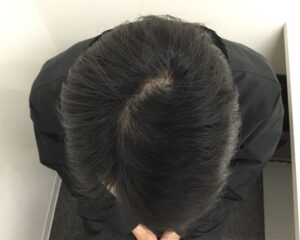 AGA治療後＿29歳男性＿生え際・頭頂部の改善＿大阪梅田院