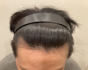 AGA治療後＿42歳男性＿生え際・頭頂部改善＿大阪梅田院