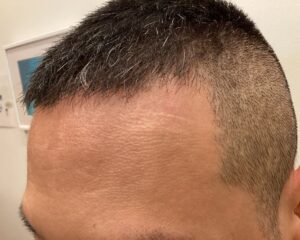 AGA治療後＿40歳男性＿生え際・頭頂部改善＿大阪梅田院