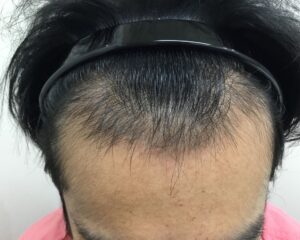 AGA治療後＿34歳男性＿生え際・頭頂部の改善＿大阪梅田院
