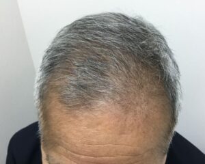 AGA治療後＿68歳男性＿生え際・頭頂部の改善＿大阪梅田院