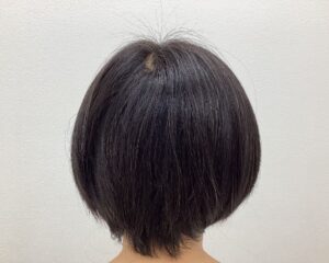 FAGA治療前 49歳女性 分け目の薄毛 横浜院