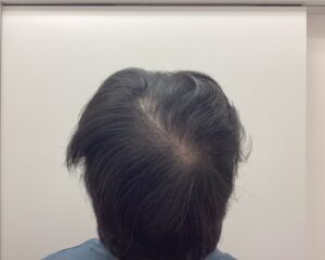 AGA治療前　28歳男性　頭頂部薄毛　新潟院