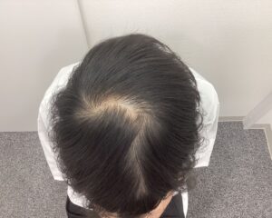 AGA治療前 25歳男性 前頭・頭頂部薄毛 新潟院