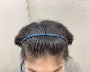 AGA治療2年後 43歳男性 生え際改善 新潟院